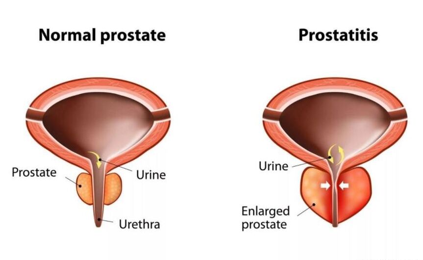 Normāla prostata un iekaisums