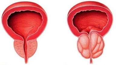Veselīga un iekaisusi prostatu ar prostatītu